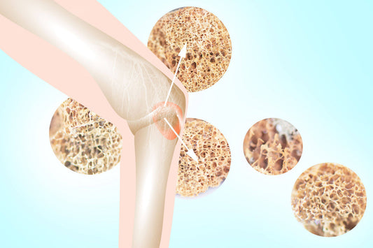 Douleur ostéoporose : 5 traitements infaillibles pour soulager vos genoux